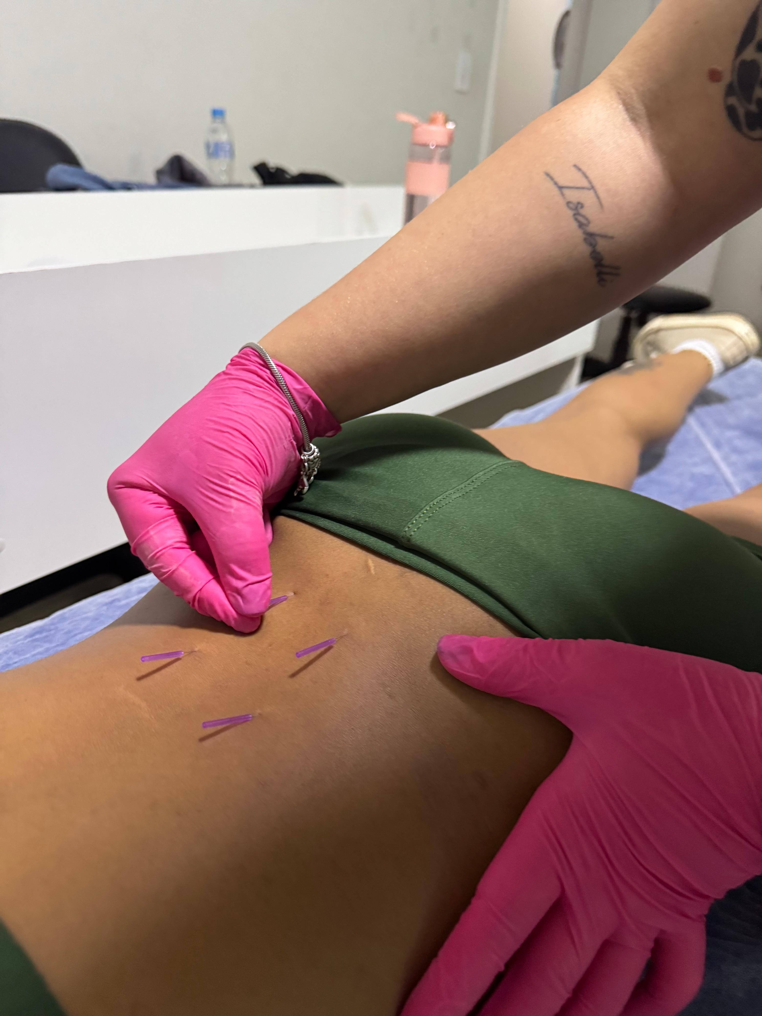 Curso de Dry Needling presencial em Maringá — prática supervisionada de agulhamento a seco